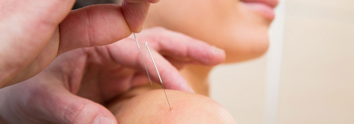 Acupuncture for Relief of Fibromyalgia Pain