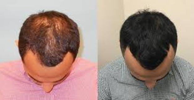 Chiropractic Calgary AB Hair Restoration 1