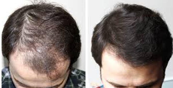Chiropractic Calgary AB Hair Restoration 2