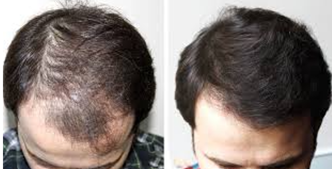 Chiropractic Calgary AB Hair Restoration 2 Chiropractic Calgary AB Hair Restoration 2