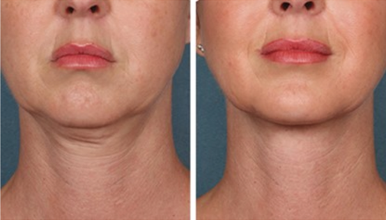 Chiropractic Calgary AB PRP Face Rejuvenation 1 Chiropractic Calgary AB PRP Face Rejuvenation 1