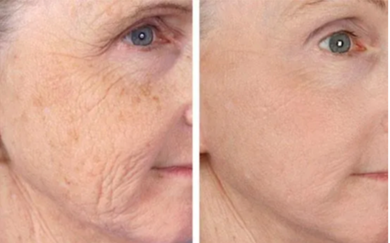 Chiropractic Calgary AB PRP Face Rejuvenation 3 Chiropractic Calgary AB PRP Face Rejuvenation 3