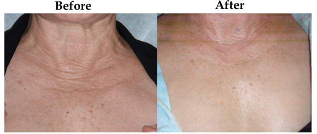 Chiropractic Calgary AB PRP Face Rejuvenation 4 Chiropractic Calgary AB PRP Face Rejuvenation 4